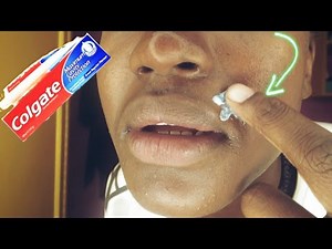 I TRIED TOOTHPASTE ON PIMPLES 😒