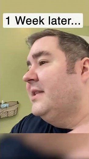 Wait till the end! Removing skin tags from home using TagBand #amazongadgets