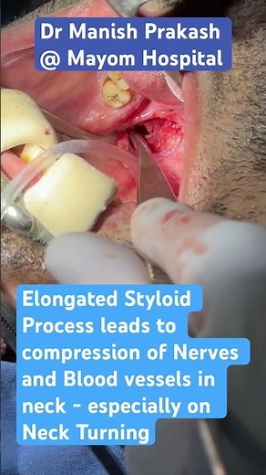 Enlarged Styloid Causing Neck Throat Pain and Globus Sensation- Treatment by Styloidectomy Surgery