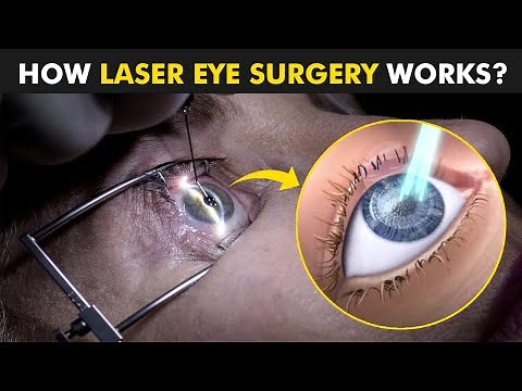 How Laser Eye Surgery (Lasik) is Performed? | Lasik plus Miami
