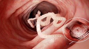 10 Early Signs of A Tapeworm to Never Ignore