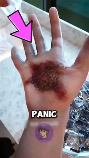 Stop Doing THIS When You Burn Yourself!