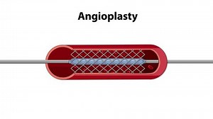 Visual sequence of a balloon angioplasty procedure