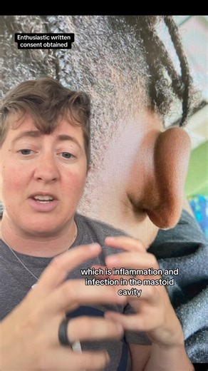 4.5M views · 134K reactions | This is an uncommon complication of swimmers ear or otitis externa, which are common during summer. This retroauricular abscess was drained and the patient is doing well! #ear #infection #case #doctor #ent Disclaimer: For educational and entertainment purposes only and should not be regarded as medical advice or replace the advice of your physician | Dr.Beachgem10 | Facebook