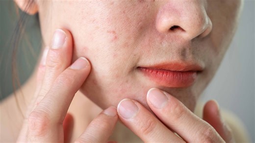 How PCOS leads to facial hair growth and what you can do about it