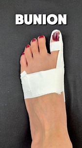1.5M views · 6.1K reactions | Corrective taping for bunions: supporting alignment, reducing pain, and improving foot function 禮#bunion #foot #tape | Kinetape Academy | Facebook