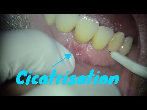Abscess under dental crown : part 2 : endodontic treatment