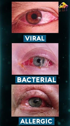 लाल आँख || How to treat Conjunctivitis or Pink Eye? 3D Animation by Armature Studios