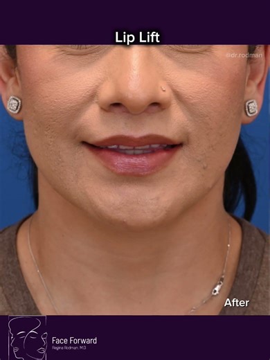 Lip Lift| Before and After| Facial Plastic Surgery