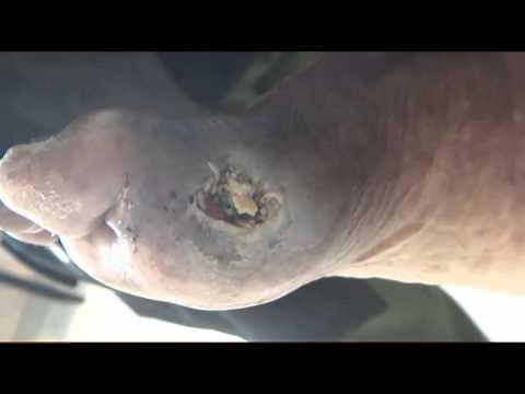 Maggots in the Wound