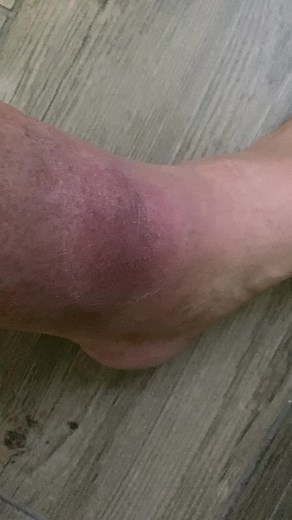 #bastelremo #kriebelmücke #mitjodsalbe#