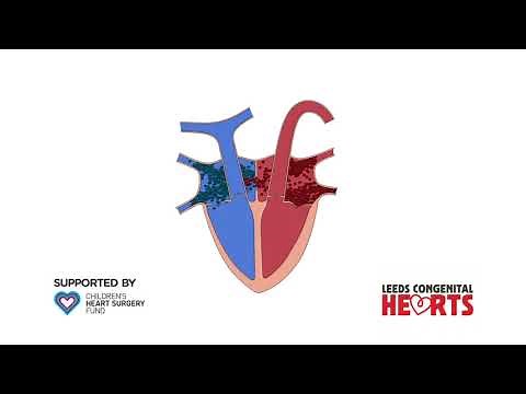 ASD and Surgical Closure