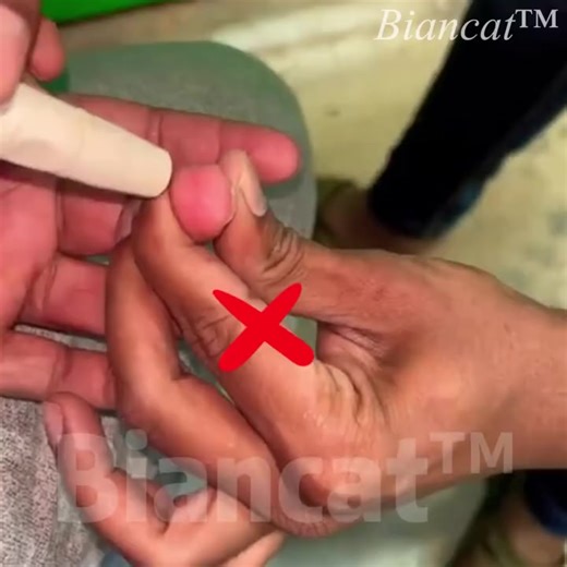 🌟 Felejtsd el az ujjbegyszúrás fájdalmát a Ceoerty™ Lézeres Vércukormérővel! Ellenőrizd a vércukrot, vérnyomást és pulzust 5 másodperc alatt, teljesen fájdalommentesen. 💡 Mesterséges intelligencia által vezérelt pontosság. Tökéletes otthoni használatra, magadnak vagy szeretteidnek. ✅ Klinikai tesztek | 💯 99,9% pontosság | 🕒 Eredmény másodpercek alatt 💶 Csak 30€ – Vigyázz az egészségedre még ma! https://www.narutal.com/hungary/products/glucose-monitoring-device. | Pure & Fresh