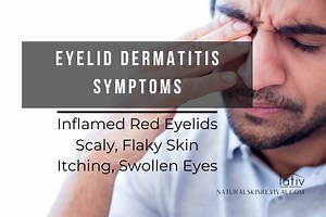 Eyelid Dermatitis Eczema: Symptoms, Cause & Treatment