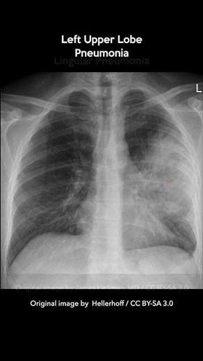 Lobar Pneumonia Chest X-rays #shorts
