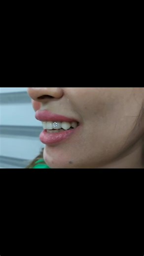 Vampire teeth look good on her and the precious diamond is just the icying on the cake 🦷🤍😍🥰🦷 | Radiant Smile Dental Clinic