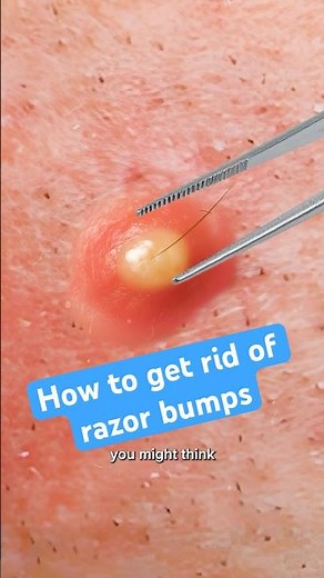 How to get rid of razor bumps