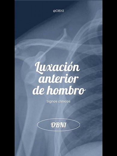 DISLOCACIÓN/LUXACIÓN ANTERIOR DE HOMBRO - SIGNOS CLÍNICOS - NO PUEDES FALLAR ESTE DIAGNÓSTICO