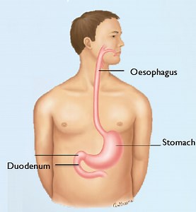 GORD Gastro-oesophageal Reflux & LPRD Laryngopharygeal Reflux Disease