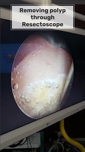 Fibroid Removal with hysteroscopy!