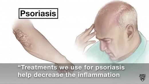 Of all the symptoms associated with psoriasis of the scalp, many patients find the itch most bothersome. Dr. Dawn Davis, a dermatologist at Mayo Clinic, explains what psoriasis is and how you can manage your symptoms. Learn more: https://mayocl.in/3ZPMvq6 | Mayo Clinic