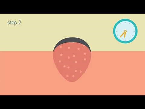 Verruca removal with silver nitrate