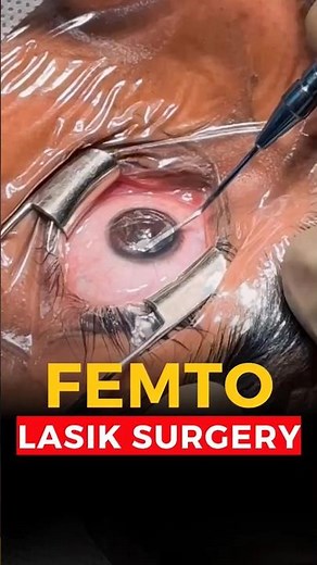 Live Femto Lasik Surgery || See Clearly Without Glasses