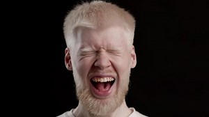 Portrait Of Freaky Albino Man Blinking Eyes And Opening Mouth Grimacing Posing Over Black Studio Background. Male Model With Albinism. Beauty And Emotions. Slow Motion