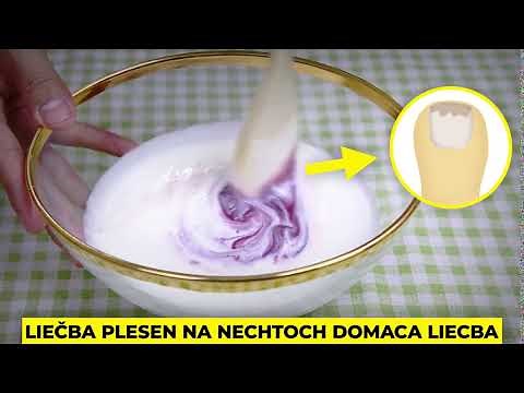 ako sa zbaviť plesne na nechtoch