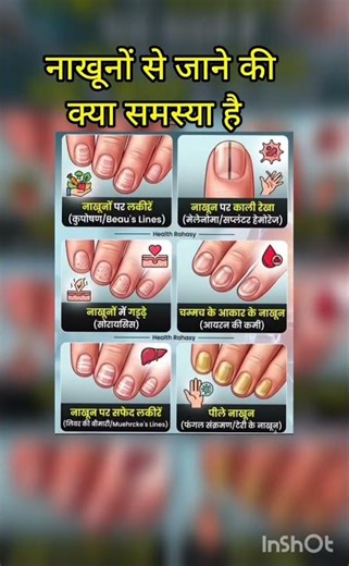 nakhun ka kharab hona | ‪@Manushree00005‬