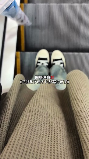 ついに病院に行きました。もう少しでこのバカデカケロイドともおさらばです。少し寂しい。#ケロイド #ケロイド界隈 #ケロイドと繋がりたい #ケロイド討伐