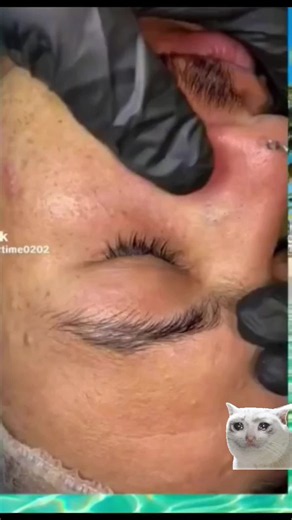 #pimples #acnee ##CapCut | Peach Slices Acne Patches