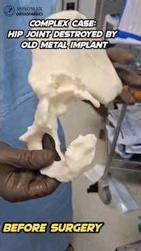 Revision Hip Replacement with 3D printing