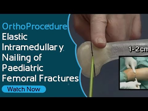 OrthoProcedure - Elastic Intramedullary Nailing of Paediatric Femoral Fractures
