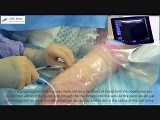 Venous Access Made Easy Video (5) • Video • MEDtube.net