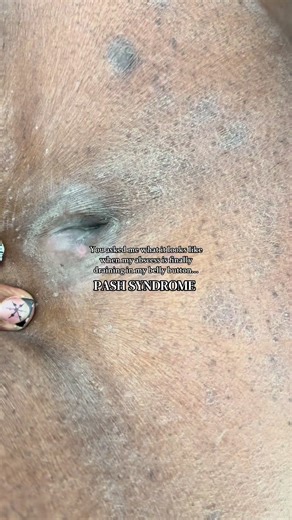 PASH syndrome in the belly button is something people rarely talk about, but it’s very real — and very painful. The belly button becomes a site of chronic inflammation, tunneling, swelling, and constant or recurring drainage. Some days it’s pressure, some days it’s pus or fluid, and other days it’s that deep ache that reminds you your body is fighting something you didn’t ask for. This isn’t hygiene. This isn’t neglect. This is an incurable inflammatory condition showing up in one of the most in