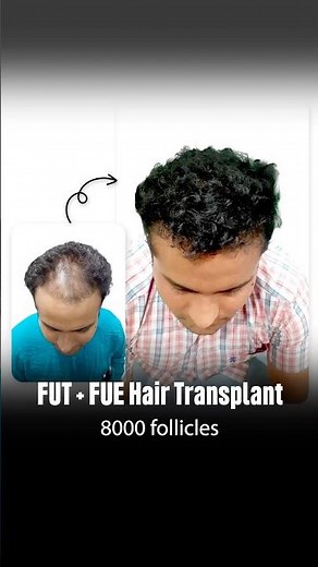 8000 Follicles Hair Transplant Result After 8 Months | FUT + FUE Transformation