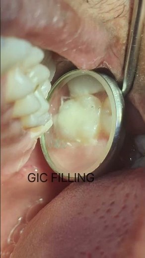 GIC restoration step-by-step: Restore teeth easily#Shorts, #GICRestauration, #DentalRestoration