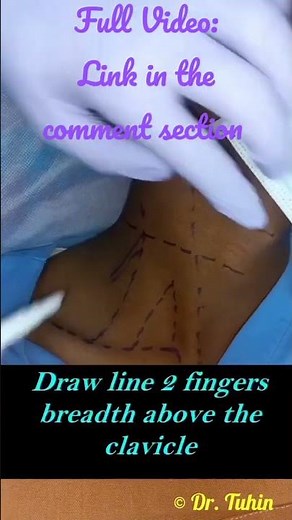 PNS-guided Low Approach Interscalene BPB