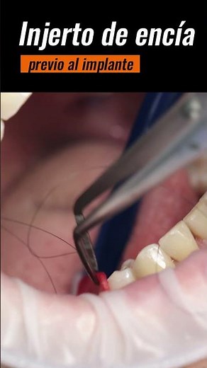 How painful is a gum graft procedure?