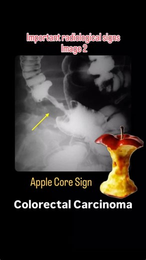 BALAJI medical education on Instagram: "--Apple Core Sign -- Colorectal Carcinoma . #mbbs #mbbsstudent #viral #medical #doctor #tranding #nursing #nursing #nursingstudent #doctors #neetpg #fmge #medicos #cancer #carcinoma #radiologystudent #radiology"
