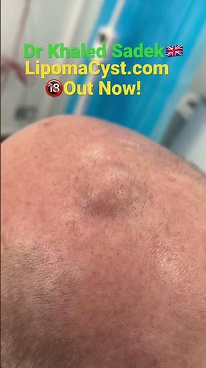 Massive Pilar cyst removal with Dr Khaled Sadek LIPOMACYST
