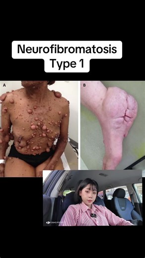 Neurofibromatosis type 1 #drkhin #knowledgesharing #neurofibromatosis
