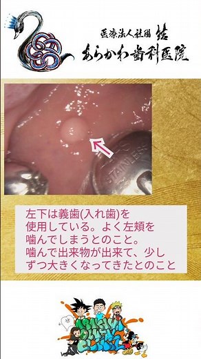 口の中のできもの…原因は些細なことにあったりします… #あらかわ歯科医院