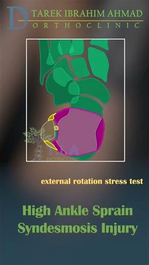 External Rotation Stress Test - High Ankle Sprain — Syndesmotic Injury
