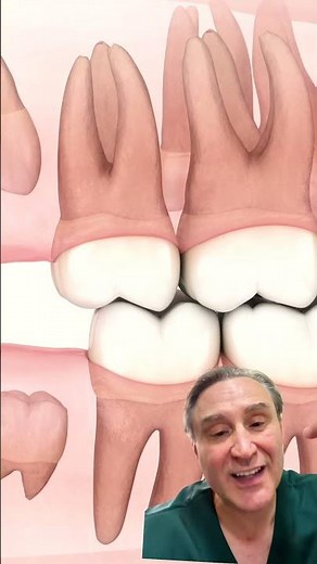 Why do you need to have your wisdom teeth removed?