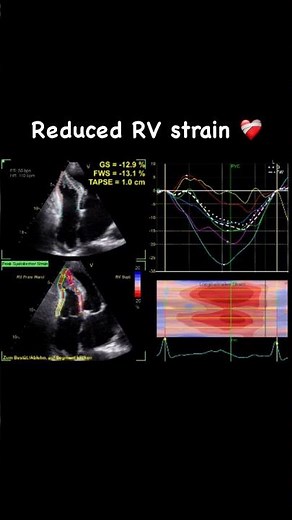 Reduced right ventricular Strain Imaging in a funnel chest 💖