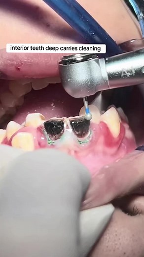 Limpieza de caries profundas en dientes interiores