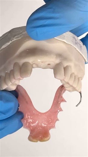 Upper Central AcryGrip Flipper Partial! Case from Dr. Michael Cheng in Illinois! | CEO Luke Kahng