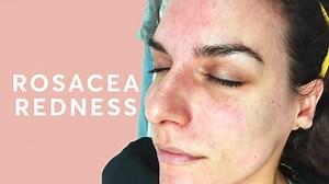 1.1K views · 4 comments | Rosacea is a medical condition where the...